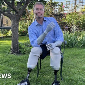 'They looked dead': MP speaks about sepsis limb loss