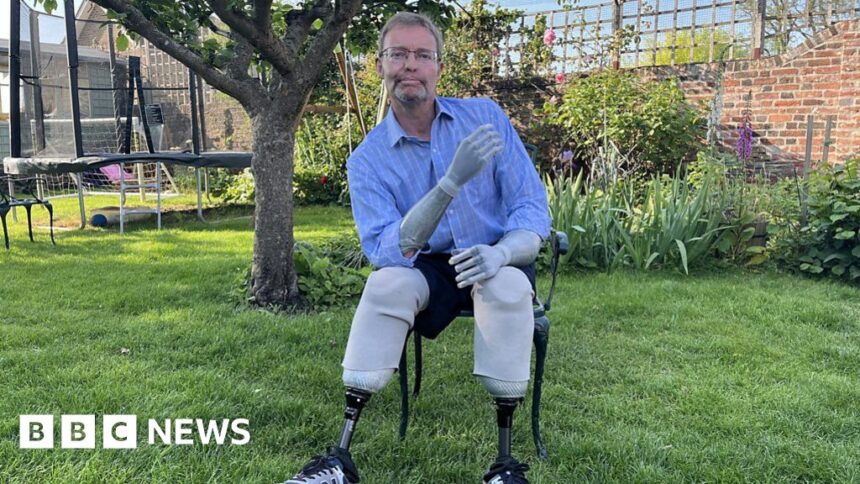 'They looked dead': MP speaks about sepsis limb loss